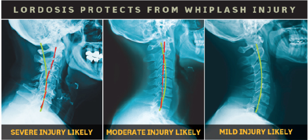 cervical neck lordosis curvature whiplash loss injury involved help crash chiropractic accident posture accidents hurt affect biophysics exercise